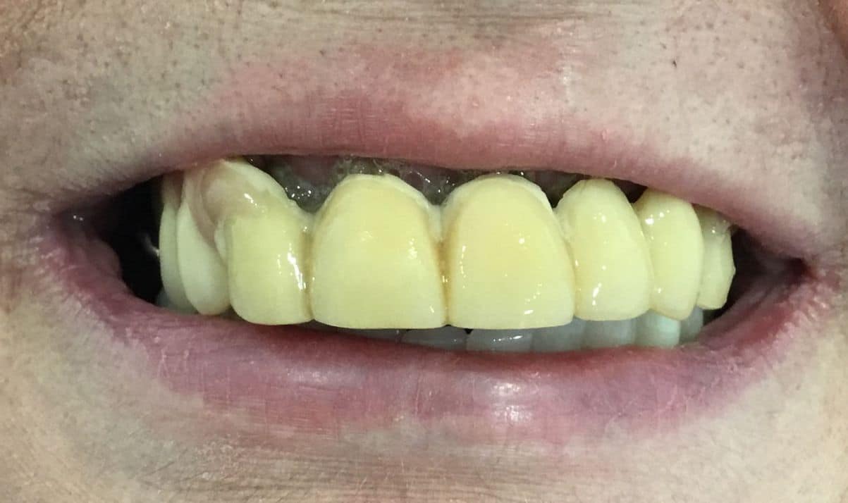 dente-6-ore-3
