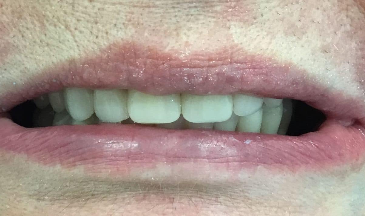dente-6-ore