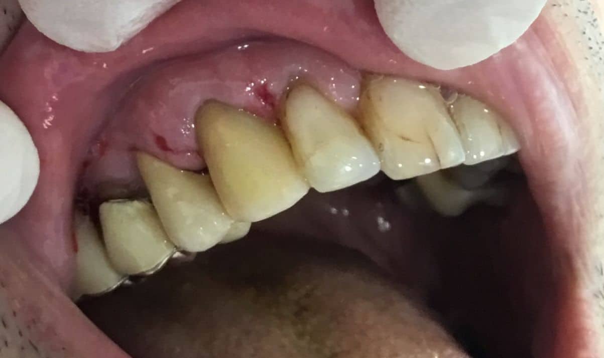 dente-fisso-6-1
