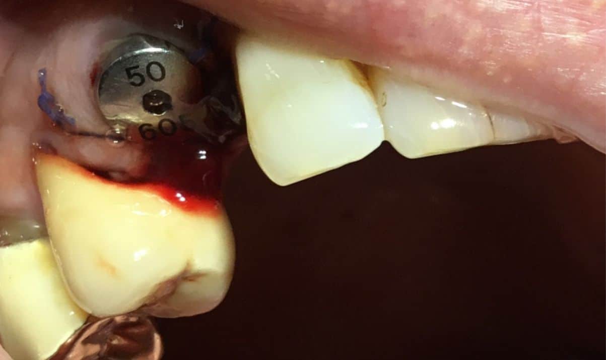 dente-fisso-6-2
