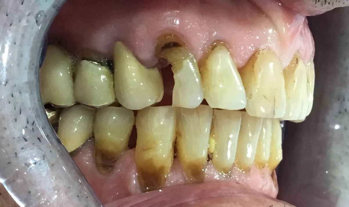 dente-fisso-6